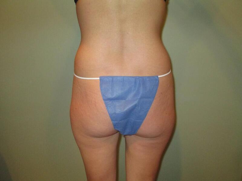 Tummy Tuck Before & After Image